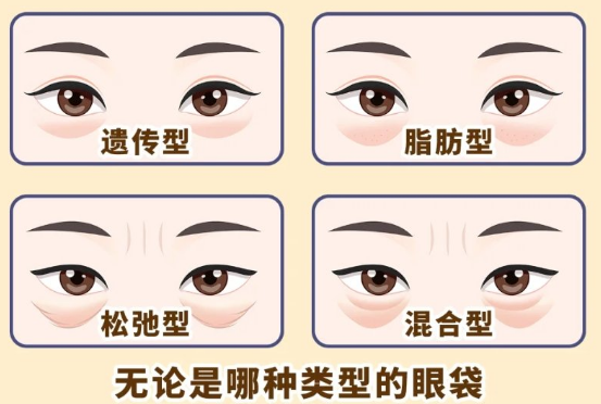 去眼袋手术
