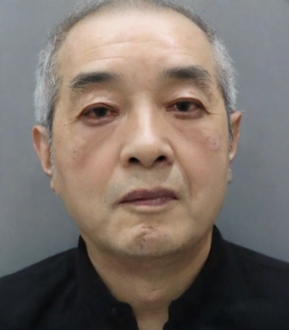 去眼袋手术