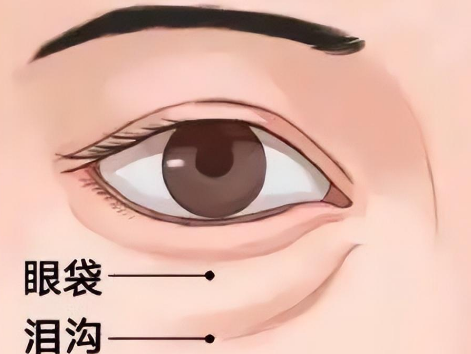 去眼袋手术