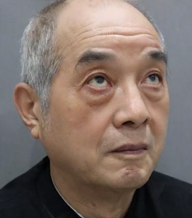 去眼袋手术