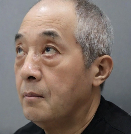 去眼袋手术