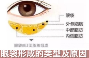 去眼袋手术