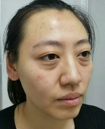 眼袋