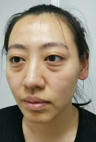 眼袋