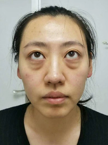 眼袋