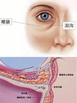 眼袋