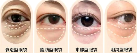 眼袋