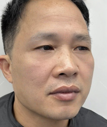 去眼袋手术