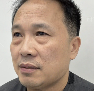 去眼袋手术