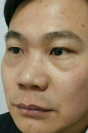 去眼袋手术
