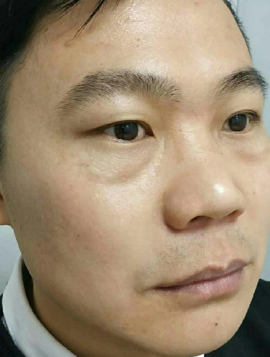 去眼袋手术