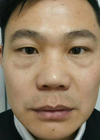 去眼袋手术