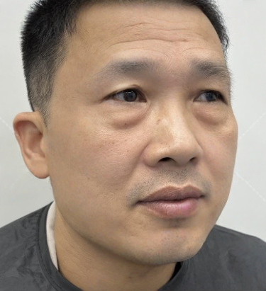 去眼袋手术