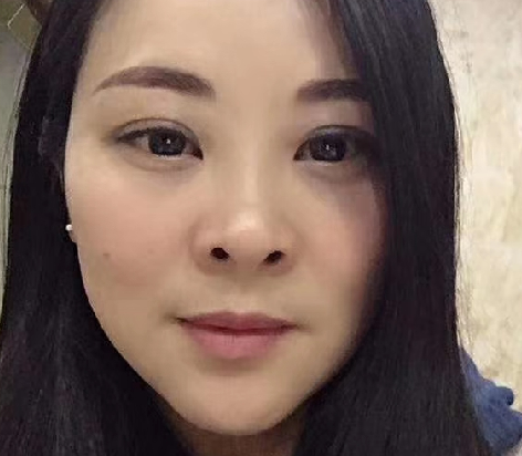 去眼袋手术