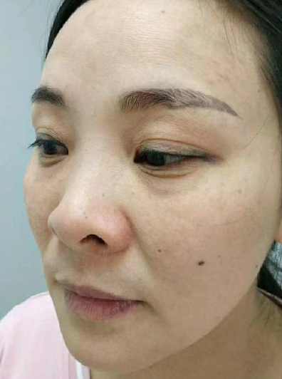 去眼袋手术