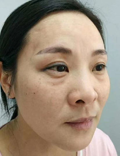 去眼袋手术