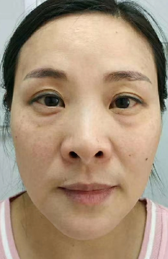 去眼袋手术