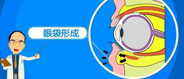 去眼袋手术