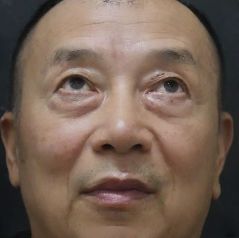 去眼袋手术