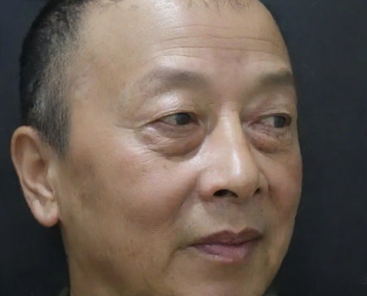 去眼袋手术
