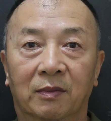 去眼袋手术