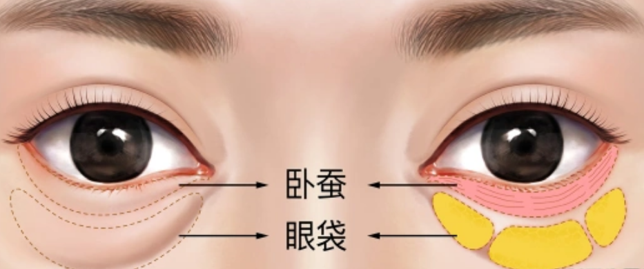 去眼袋手术