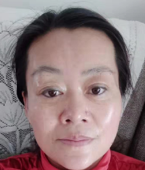 去眼袋手术