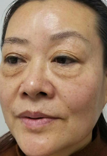 去眼袋手术