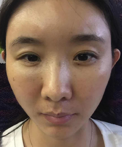 去眼袋手术