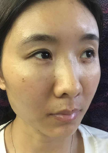去眼袋手术