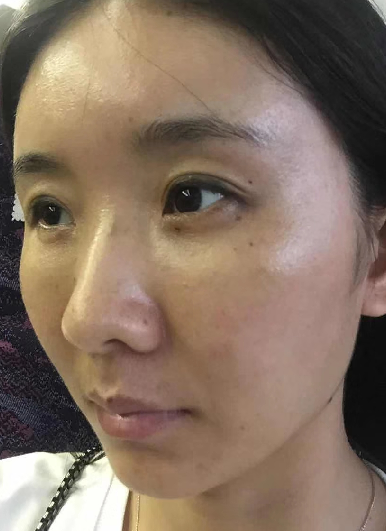 去眼袋手术