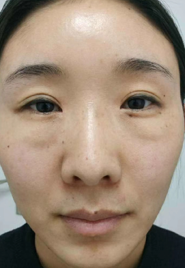 去眼袋手术