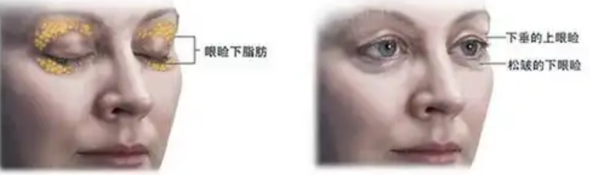 去眼袋手术