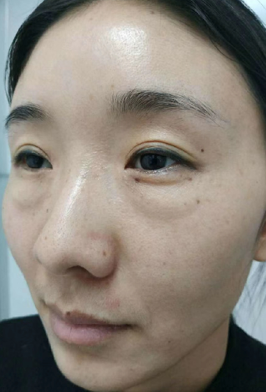 去眼袋手术