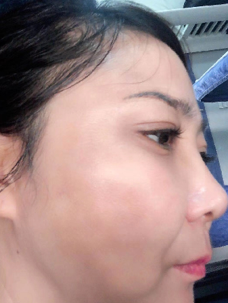 去眼袋手术