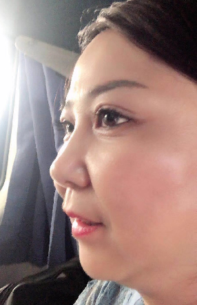 去眼袋手术