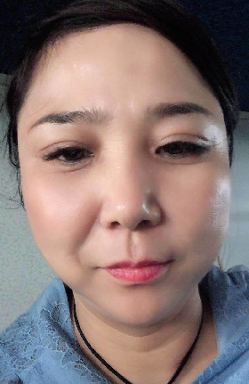去眼袋手术