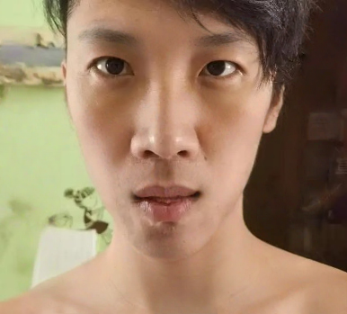 去眼袋手术
