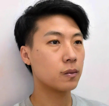 去眼袋手术