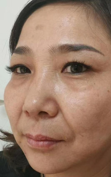 去眼袋手术