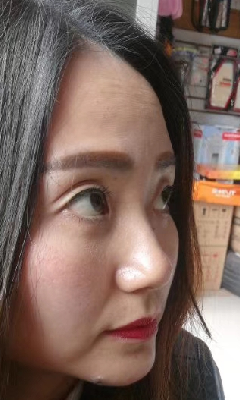 去眼袋手术