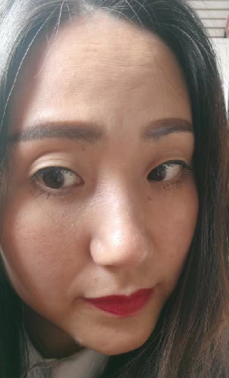 去眼袋手术