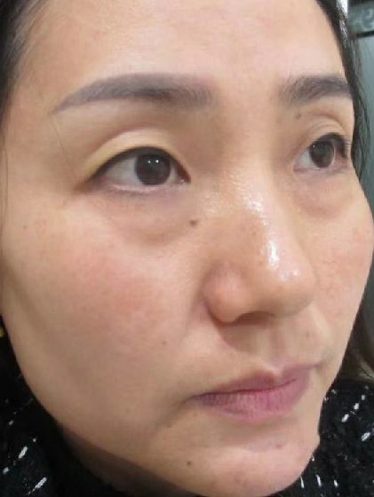 去眼袋手术