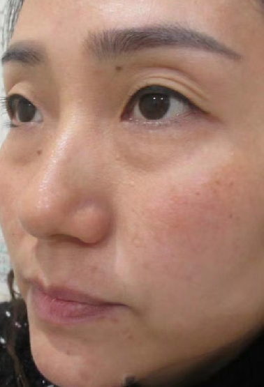 去眼袋手术