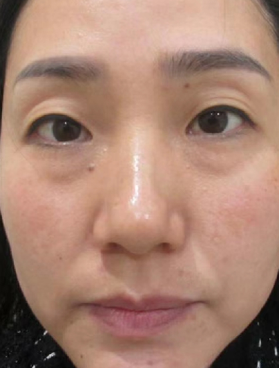 去眼袋手术
