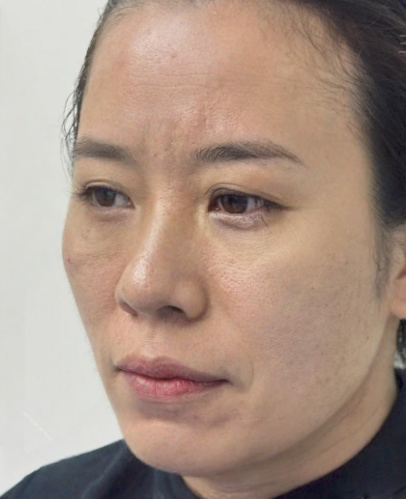 去眼袋手术
