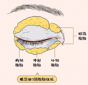去眼袋手术