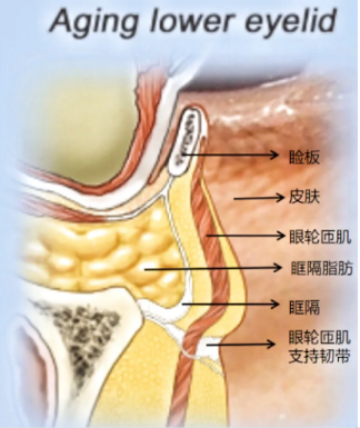 去眼袋手术
