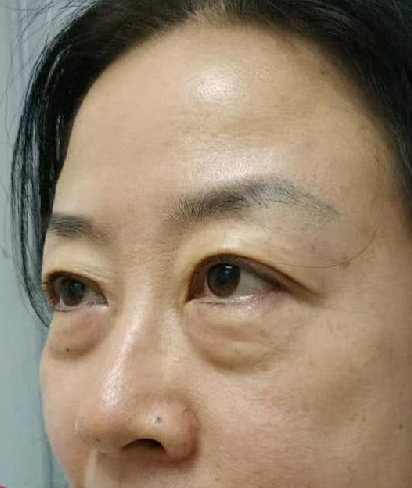 去眼袋手术