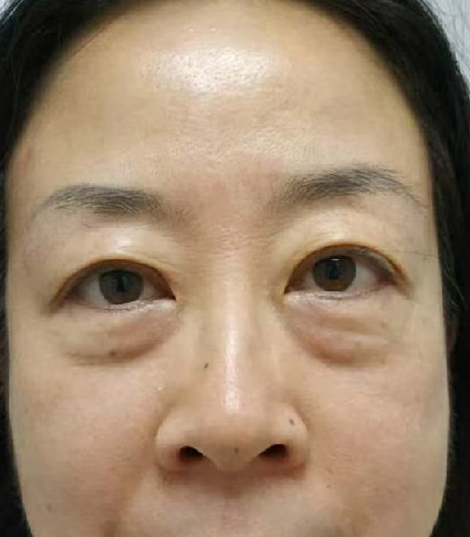 去眼袋手术